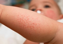 Как отличить аллергическую сыпь от потницы у ребенка?